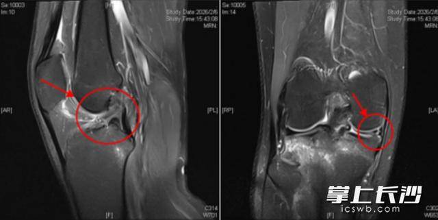 球場上急停變向，留學生膝關節“亮紅燈”！警惕這四類訊號