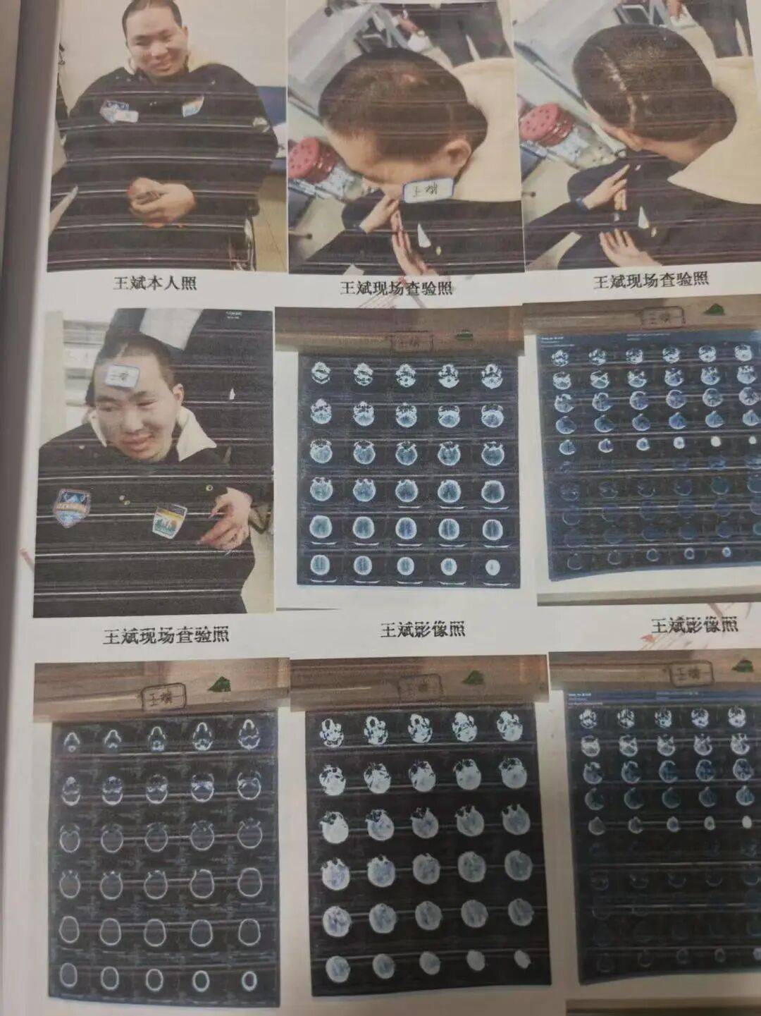 16歲少年無證駕車撞倒23歲研究生，致其顱腦損傷心智如幼童