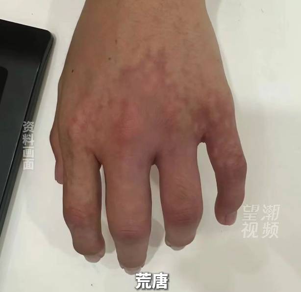 老闆迷信“指縫寬易漏財”，到美容院給手指打玻尿酸，致整隻手掌血管栓塞