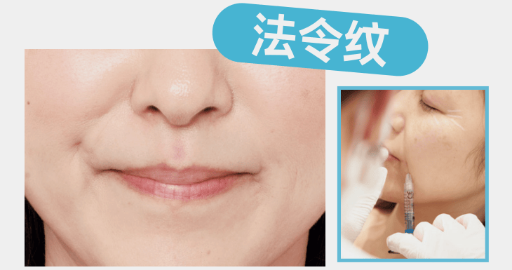 醫療美容 | 表情紋、眼周紋、法令紋，針對性改善！