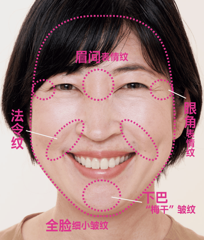 醫療美容 | 表情紋、眼周紋、法令紋，針對性改善！