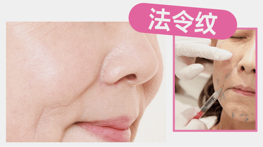 醫療美容 | 表情紋、眼周紋、法令紋，針對性改善！