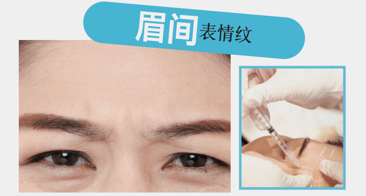 醫療美容 | 表情紋、眼周紋、法令紋，針對性改善！