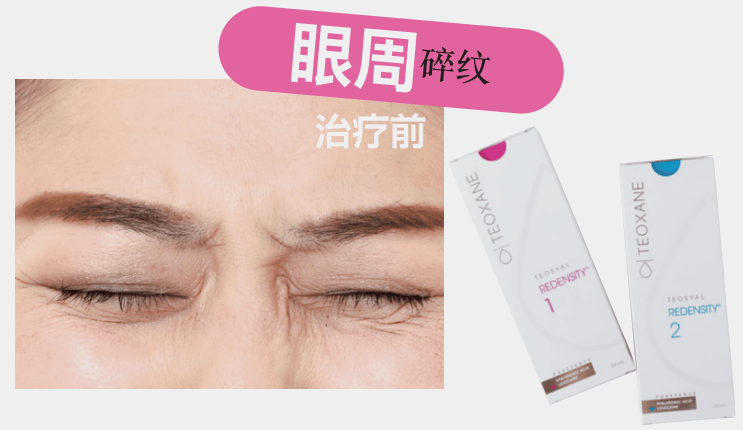 醫療美容 | 表情紋、眼周紋、法令紋，針對性改善！