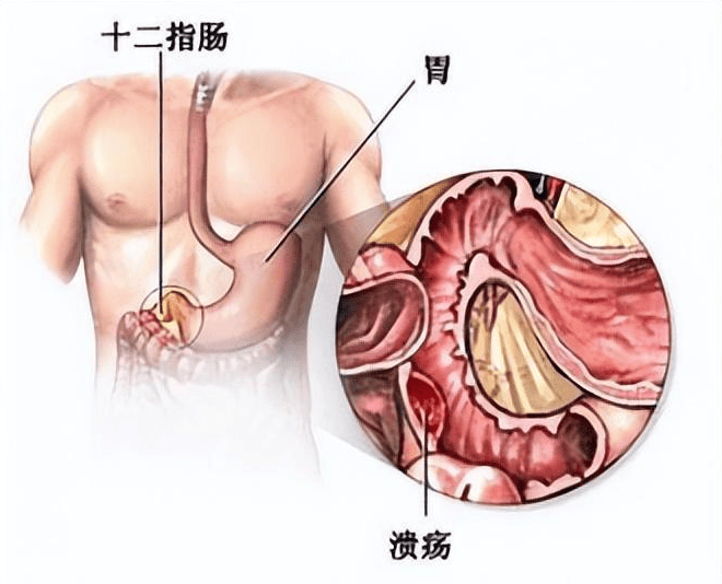 科普 | 快速認識消化性潰瘍